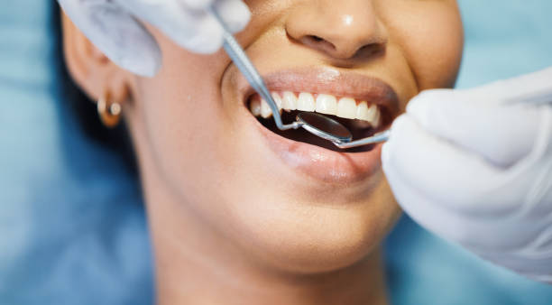 Best Knocked-Out Tooth (Avulsed Tooth) Treatment in Clemson University, SC