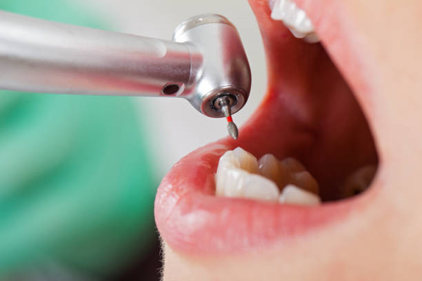 Best Lost Filling or Crown Replacement in Clemson University, SC
